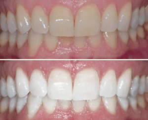 zoom teeth whitening